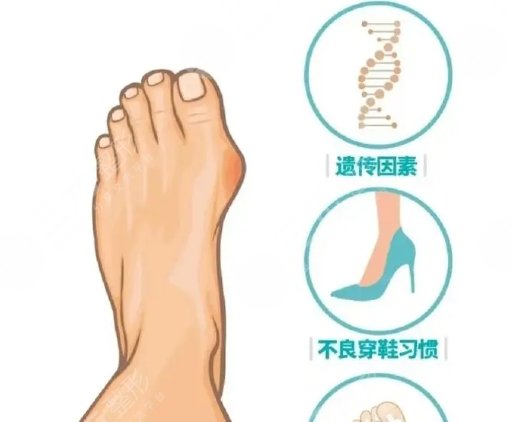 大脚骨外翻