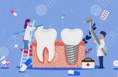 德国种牙种植体哪个品牌好？汇总3款常用材料，术前必看！