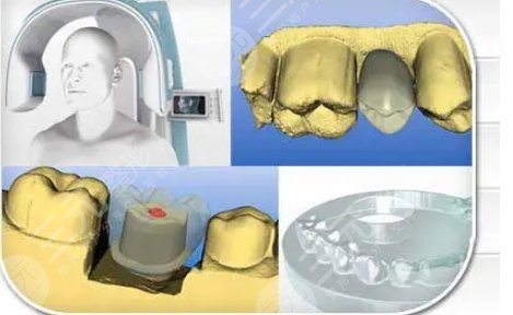 德国亲骨种植系统