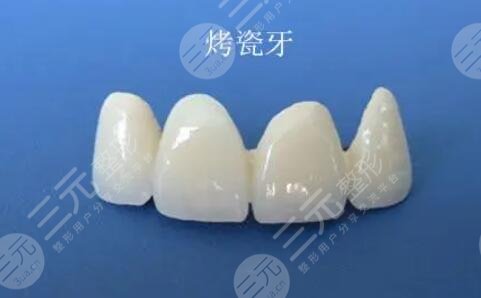 烤瓷牙