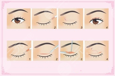 闫家峰做双眼皮怎么样?热门医生简介,案例反馈为你揭晓!