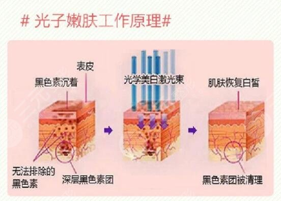 上海九院整复外科光子嫩肤案例