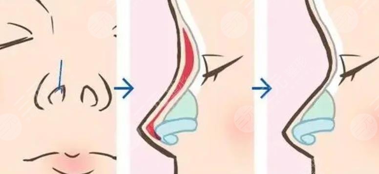 上海第六人民医院整形外科隆鼻案例