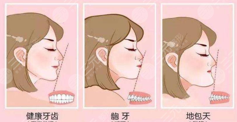上海华山医院牙齿矫正案例