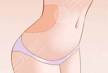 剖腹产疤痕修复