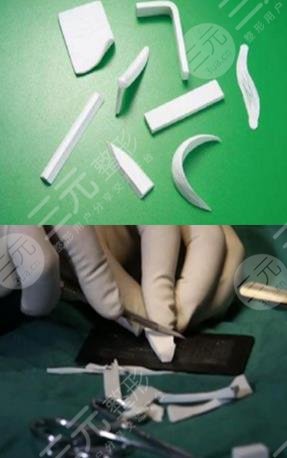 上海同济医院整形外科假体隆鼻案例