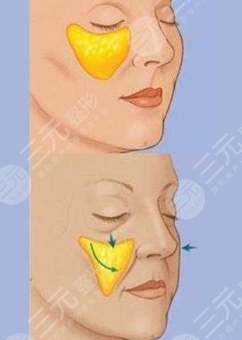 上海九院脂肪填充面部案例