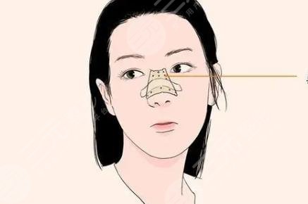 进口膨体和国产膨体有什么区别