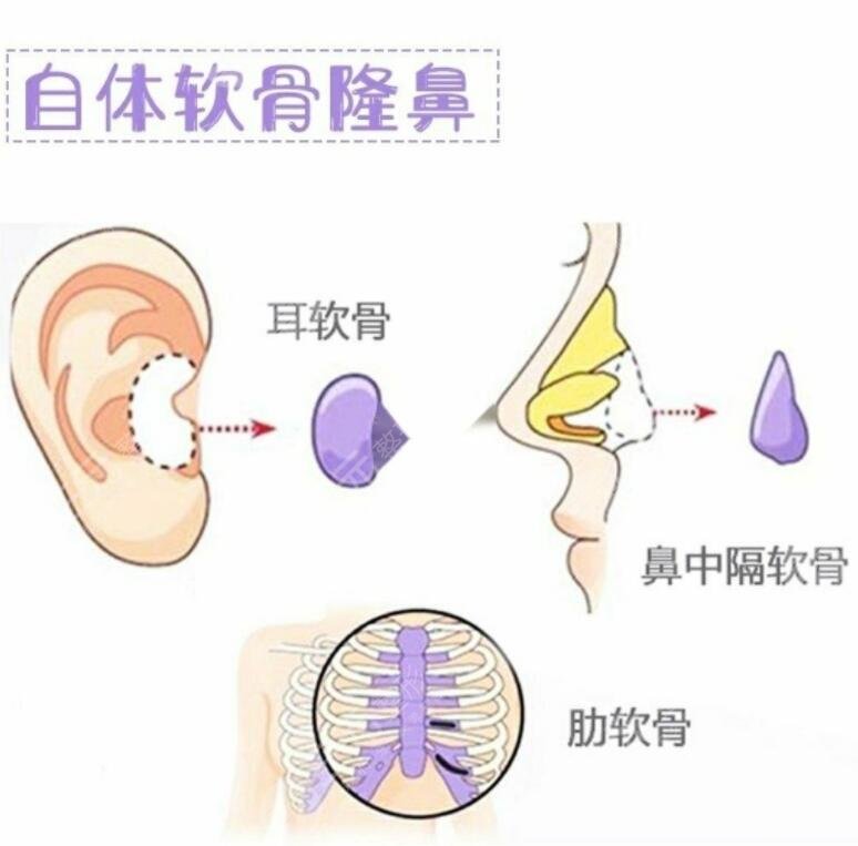 刘军医生肋骨鼻整形案例分享
