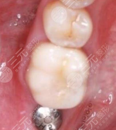 陆永健医生种植案例