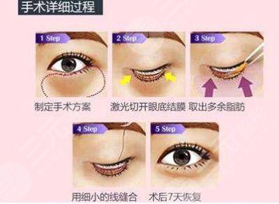 哈尔滨雅美整形医疗美容医院价格表更新！去眼袋术后点评，避坑！