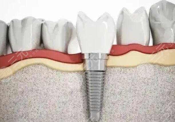 仕诺康SNUC种植牙