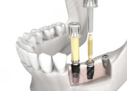 纽百特NEO种植牙