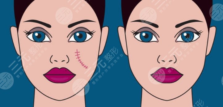 上海第一人民医院去疤痕怎么样