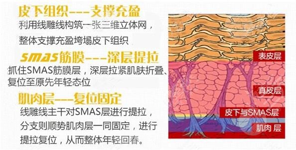 筋膜提升术有哪些优势?
