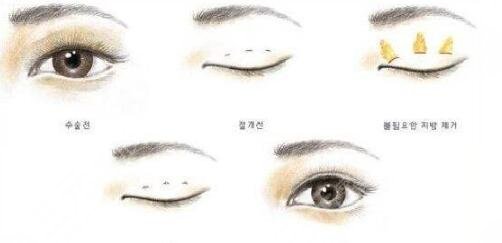 北京中关村医院双眼皮案例分享