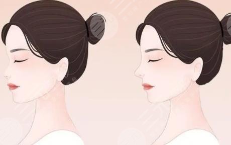 隆鼻