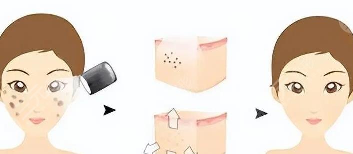 激光