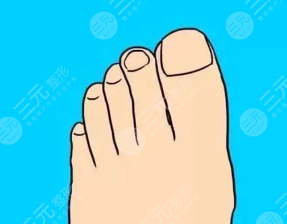 脚趾缩短手术