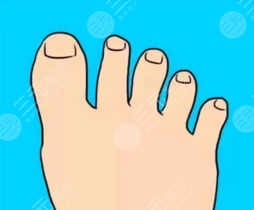 二脚趾缩短手术