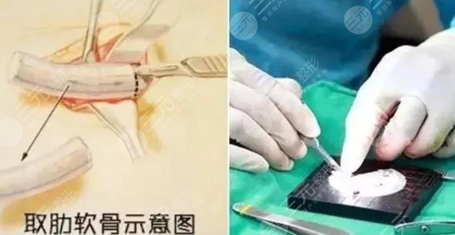 上海六院整形科隆鼻案例