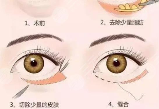 上海东方医院去眼袋挂什么科