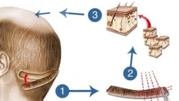 上海第一人民医院植发多少钱
