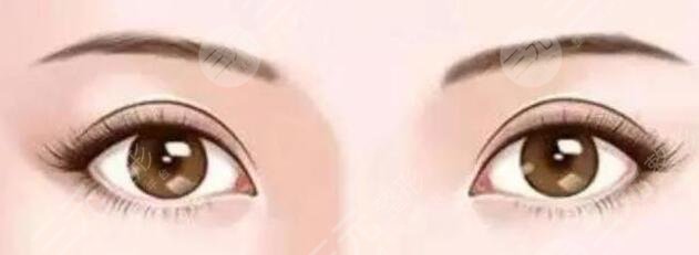 双眼皮