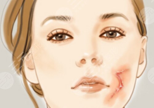 武晓莉疤痕修复手术好吗？