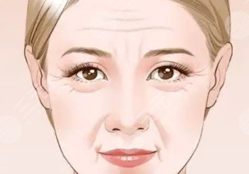 筋膜悬吊面部提升术价格