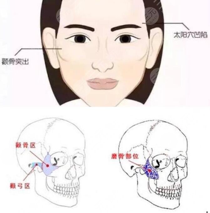 北京磨骨医生张立天做的磨骨手术案例,坐诊医院_术后点评