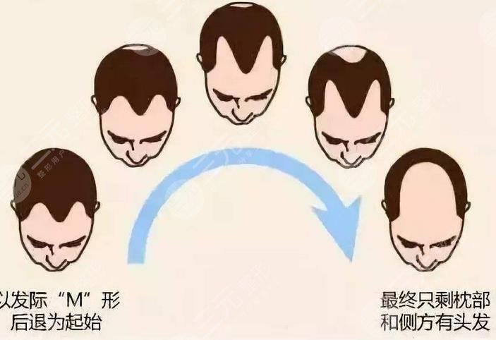 上海九医院植发案例