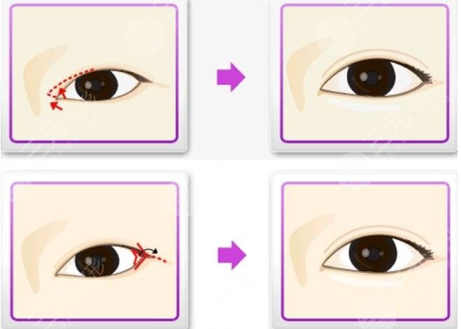 上海六院美容科开眼角案例