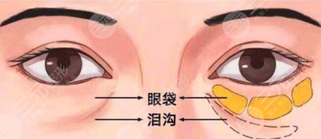 内切去眼袋