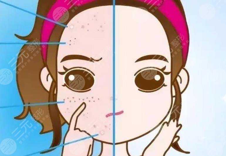 上海国际医院皮肤科点阵激光去痘印案例
