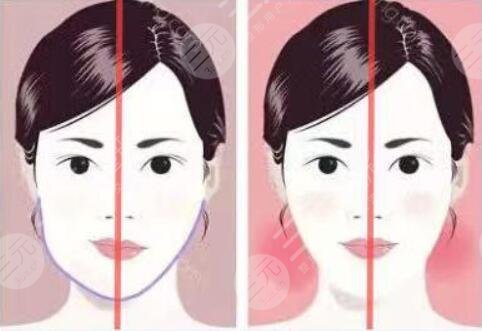 下颌骨一高一低脸歪怎么矫正？左右脸不对称能矫正过来吗？