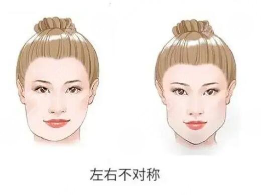 下颌骨一高一低脸歪怎么矫正？左右脸不对称能矫正过来吗？