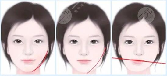 下颌骨一高一低脸歪矫正后需要怎样护理?