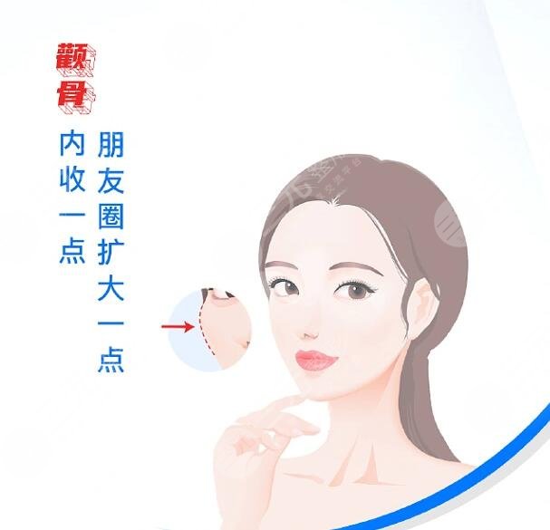 上海华山医院颧骨整形案例分享
