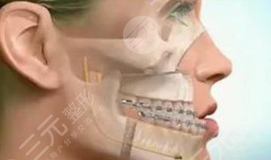 正颌手术