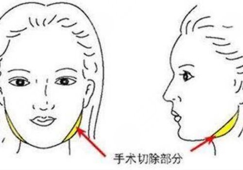 削骨三年后的真实案例