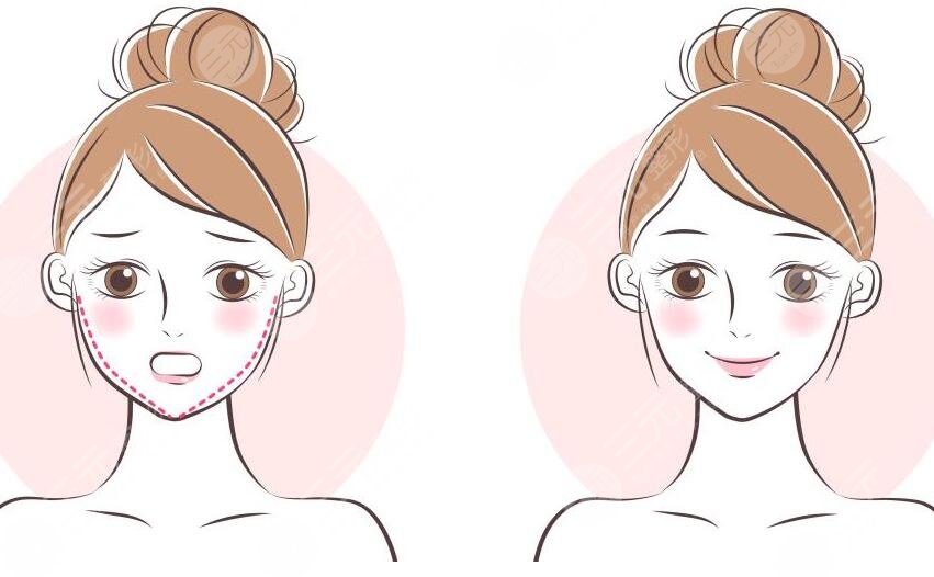 发腮脸变宽了还能变回去不？