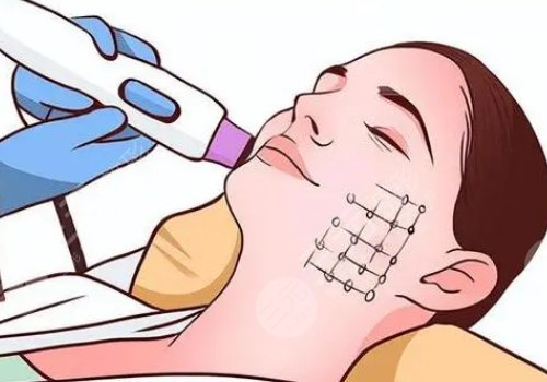 热玛吉是不是能量越高效果越好？