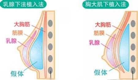 彭才学医生隆胸案例分享