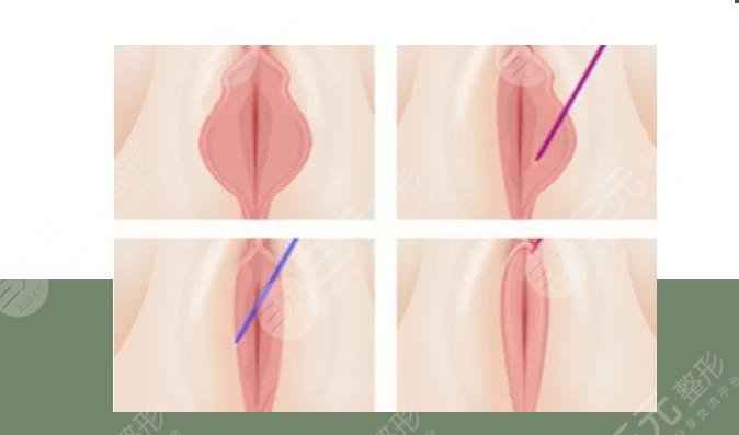 女性私密紧致手术后的改变好吗