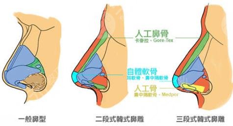 隆鼻