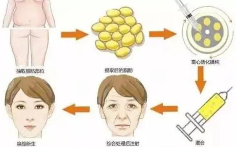 袁玉坤医生脂肪填充案例分享