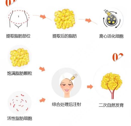 王荣锡医生做脂肪填充怎么样