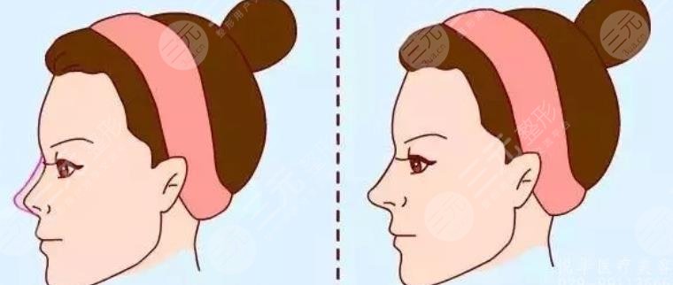 唐鏖医生修复鼻子案例