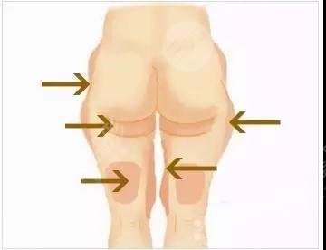 曾德浩医生吸脂怎样？简介&案例测评！广州荔医高人气之选~